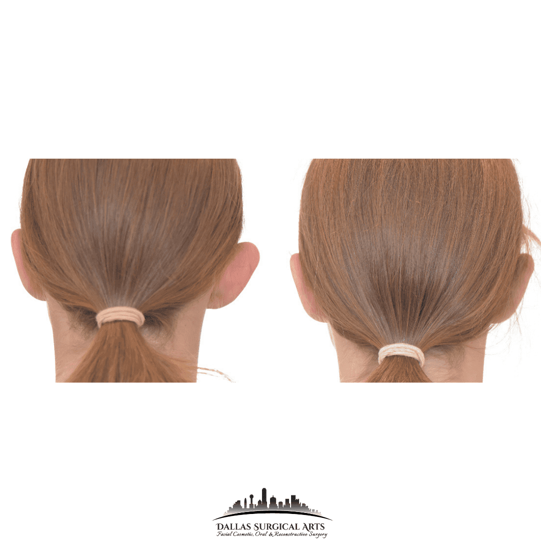 Dallas Otoplasty Surgeon Dr Randy Sanovich Dallas Surgical Arts