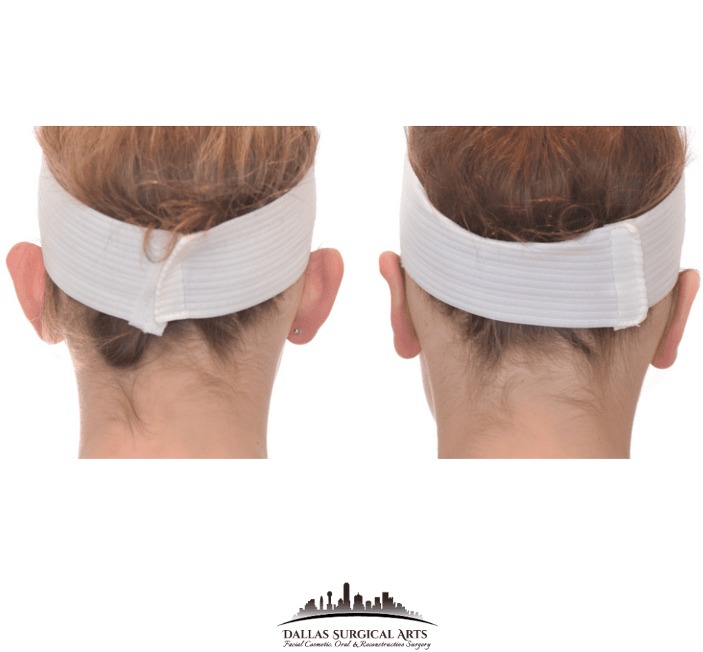  Otoplasty Dallas Ear Surgery by Dr. Randy Sanovich at Dallas Surgical Arts